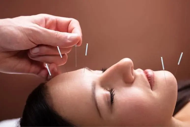 An acupuncturist inserts needles at pressure points in a woman’s face in holistic addiction treatment