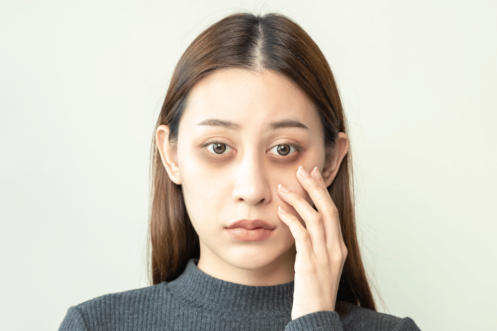 On an alcoholic face, there are often dark circles under the eyes, Avenues Recovery explains.