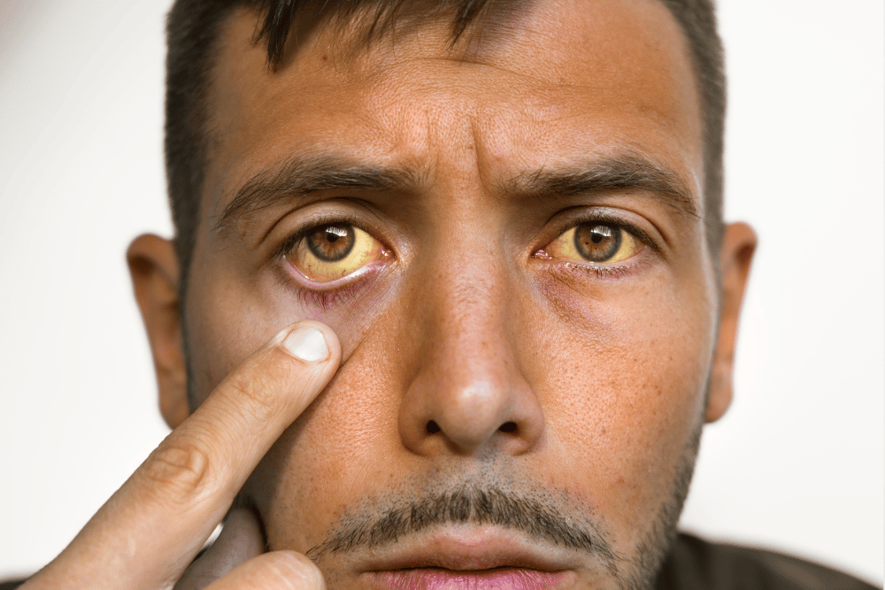 Jaundice is a sign of an alcoholic face, Avenues Recovery notes.