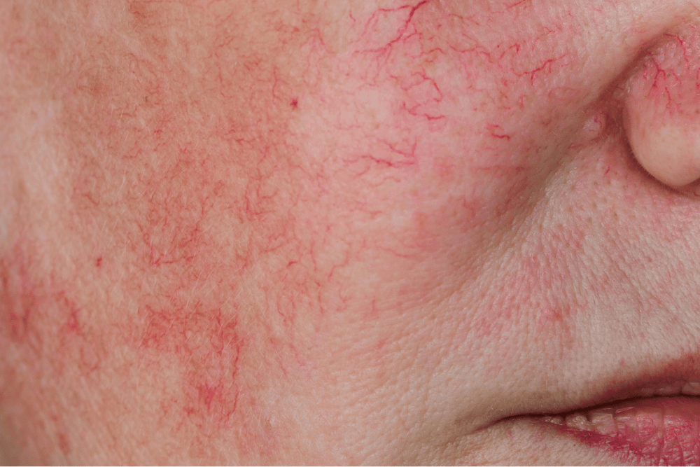 An alcoholic face often has spider veins, Avenues Recovery explains.