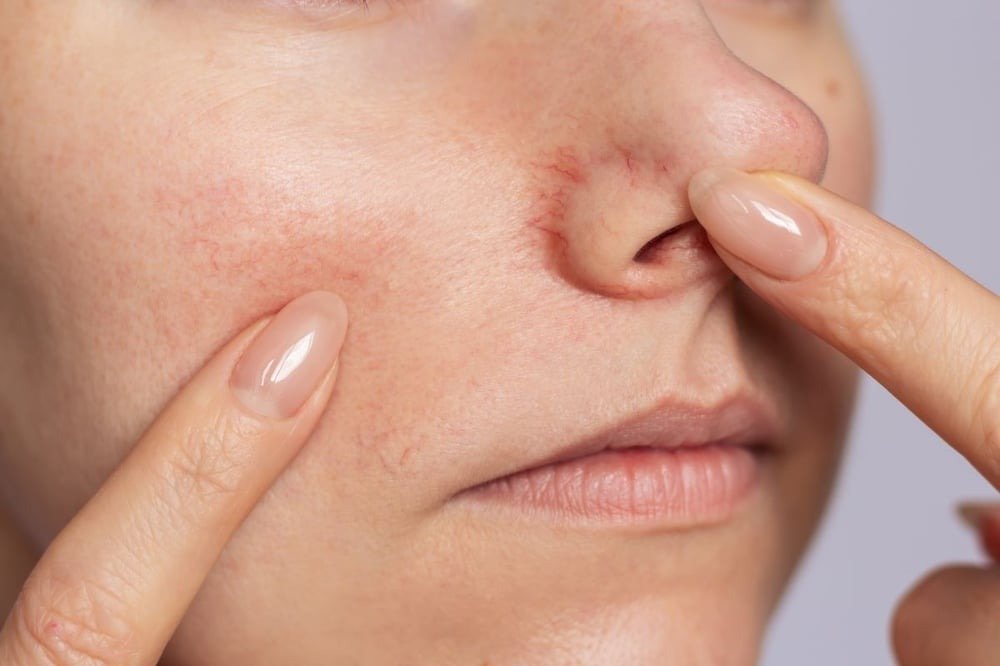 Close-up of facial redness and irritated skin that may be caused by alcohol inflammation.