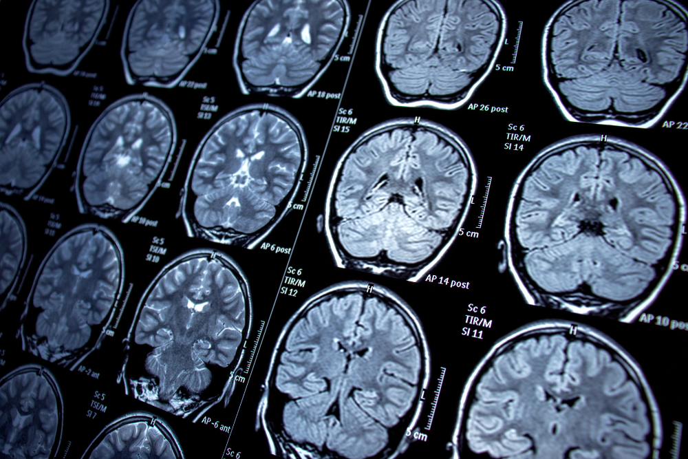 MRI scans showing brain activity during delayed seizure from Wellbutrin overdose. Avenues Recovery.