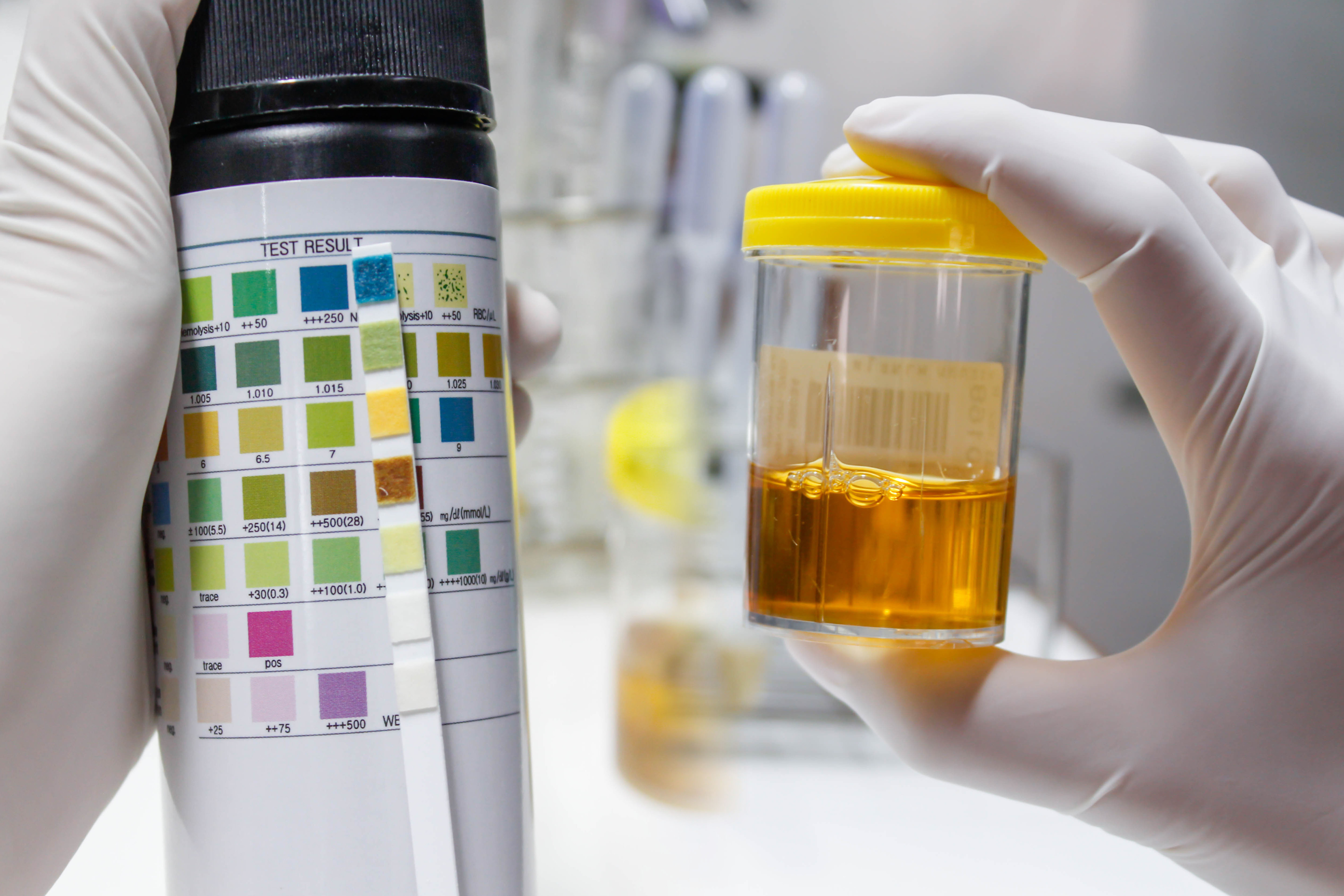 How long gabapentin stays in your system is evident with a urine analysis, Avenues Recovery notes.