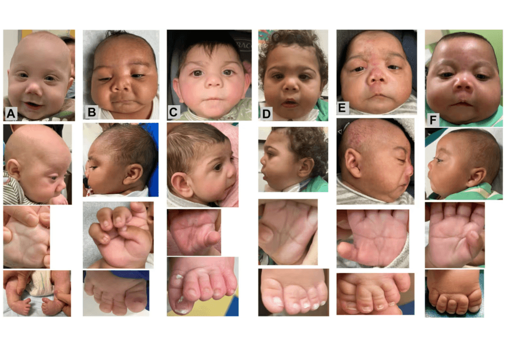 Pictures of faces and limbs of babies with suspected fetal fentanyl syndrome.
