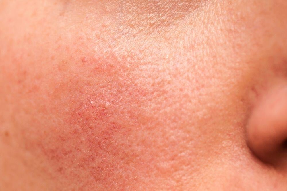 Red face from alcohol, explained by Avenues Recovery