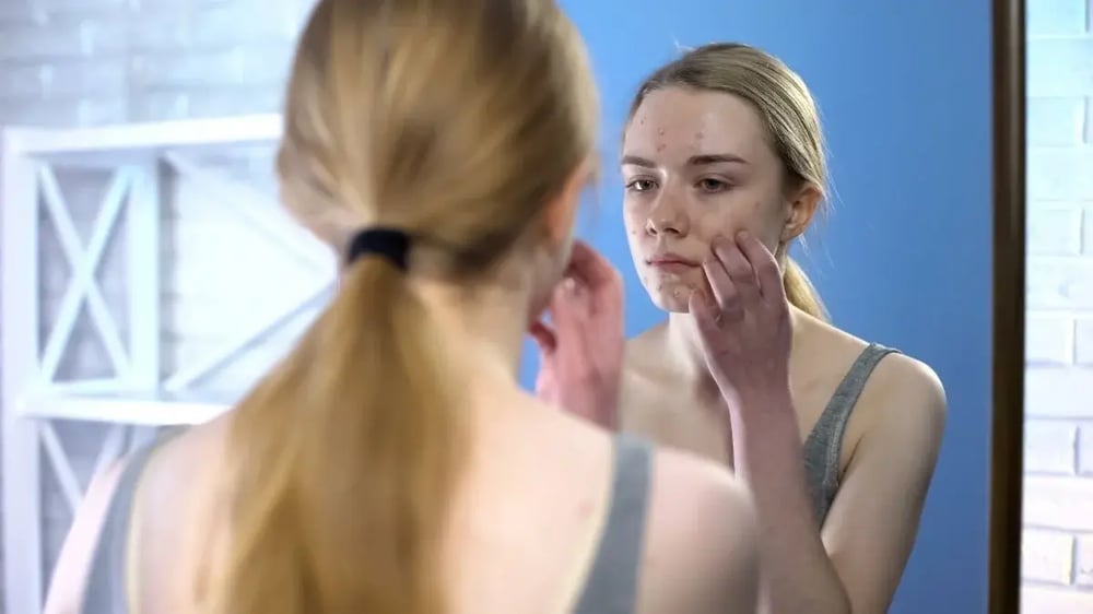 A young woman examines her acne in the mirror. Is her acne caused by alcohol?