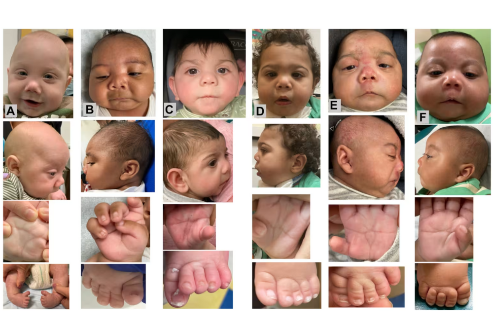 The common abnormalities in the six babies found to have Fentanyl Baby Syndrome in a study