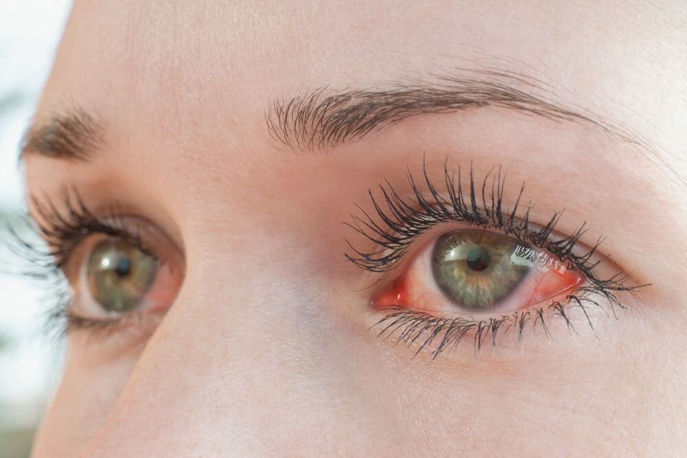 red eyes, sign of Sudafed addiction, explained by Avenues Recovery
